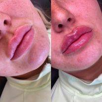 Lip Fillers Before and After