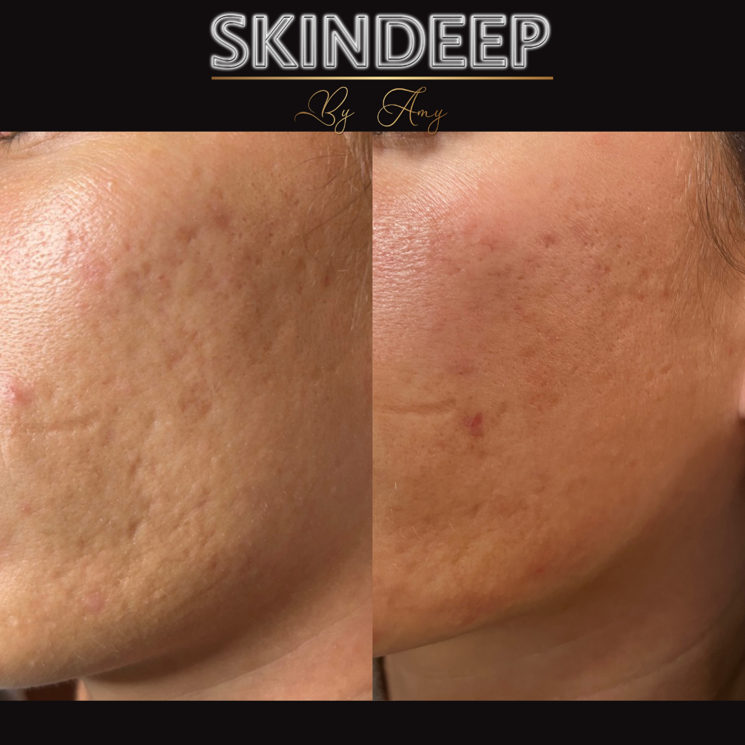 Treating Acne scarring with regular Microneedling