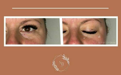 Soin Expert anti-âge - Résultat en 1 séance