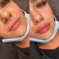 Lip Fillers Before and After