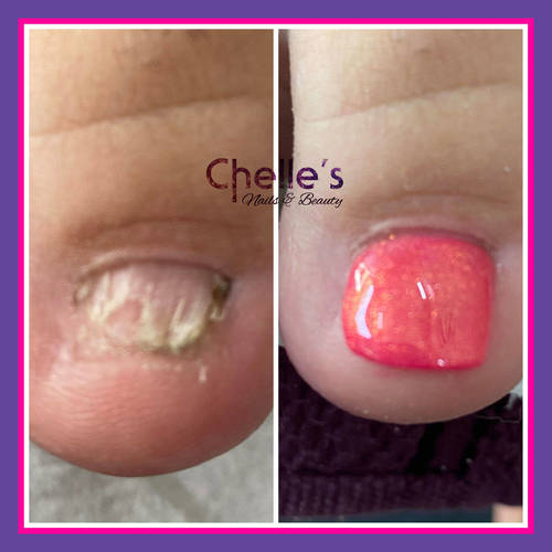 Toe nail reconstruction 