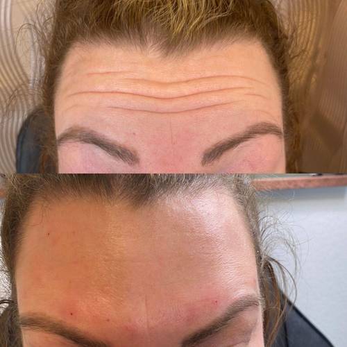 Botox Before and Afters