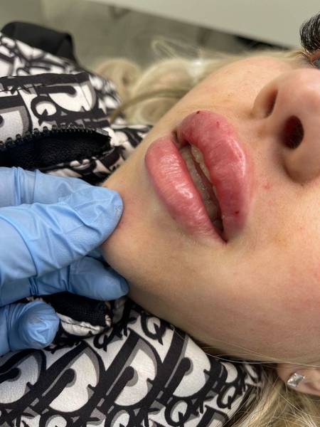 1.1ml Lip Enhancement 