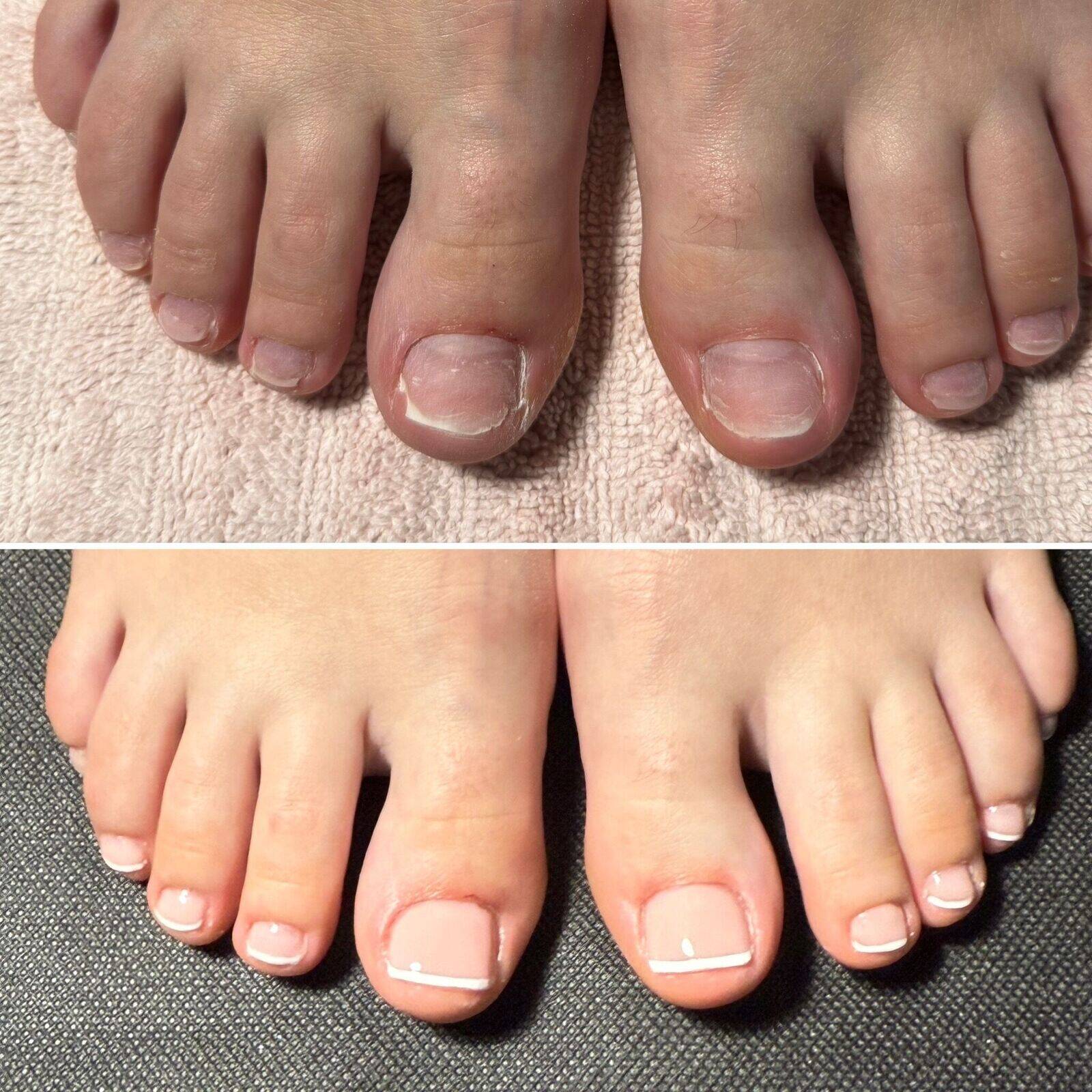 Avant VS Après : Reconstruction ongulaire