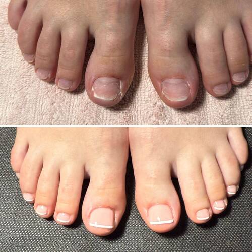 Avant VS Après : Reconstruction ongulaire