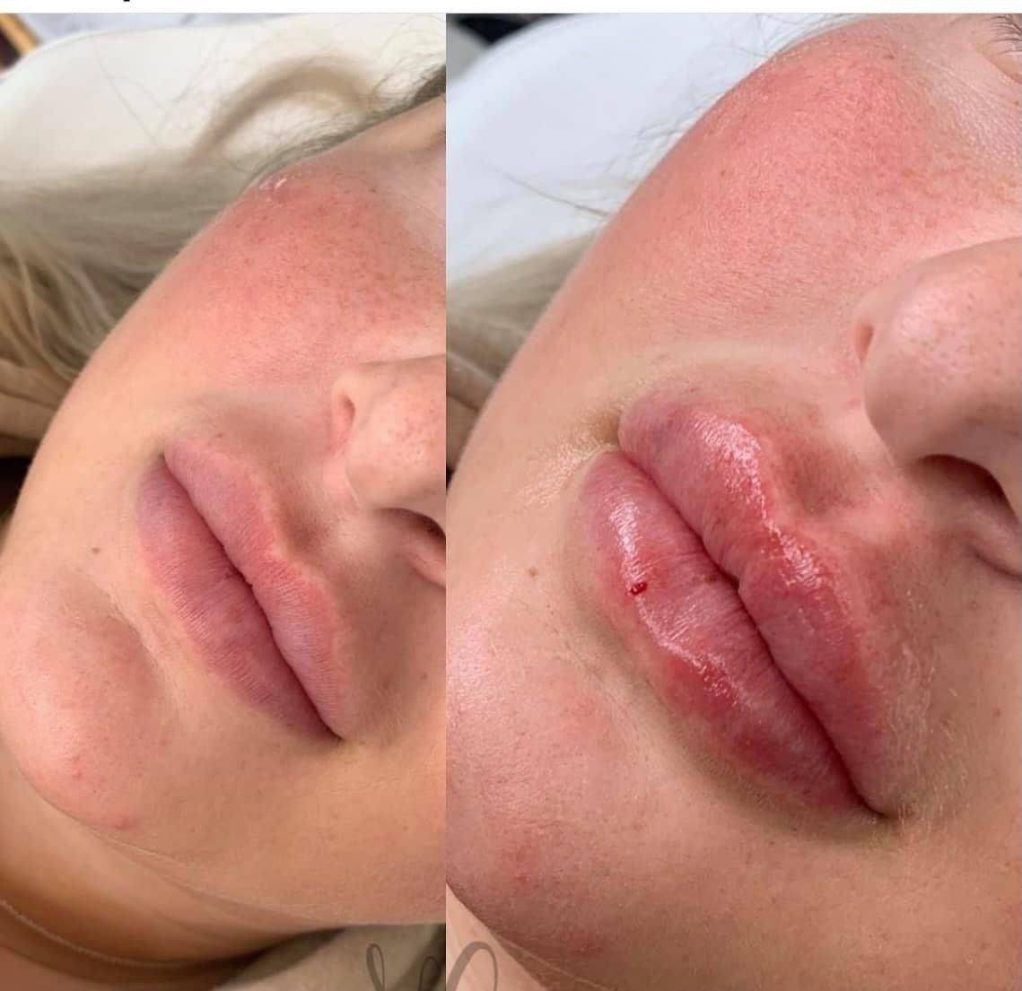 1.1ml Lip Enhancement 