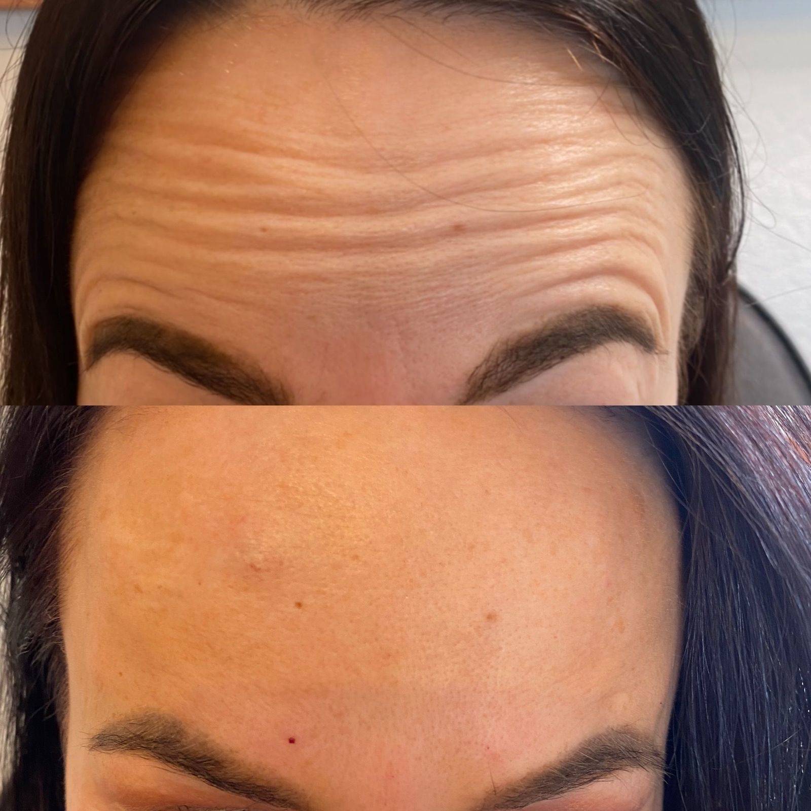 Botox Before and Afters