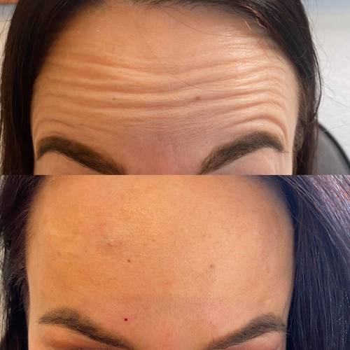 Botox Before and Afters