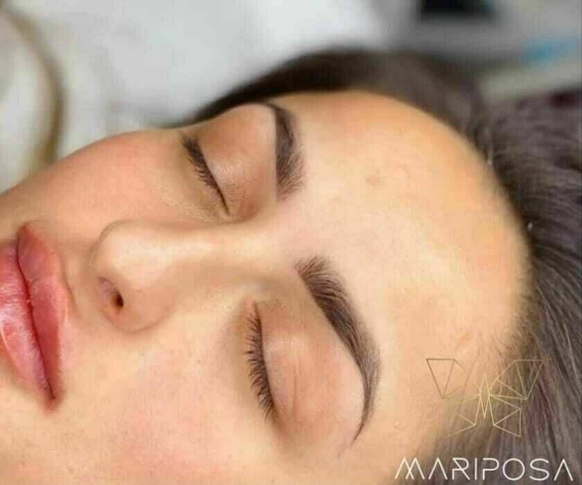 Abgeheilte Augenbrauen vor der Nachbehandlung 