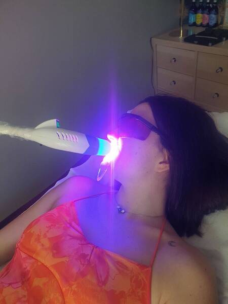 Blanchiment dentaire 