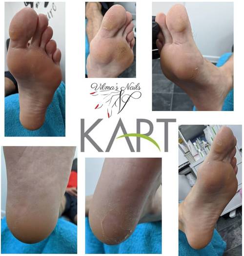 Not just ladies need look after feet mens too. Never to late everyone should start. Not wait and book. Done Kart Pedicure Treatment. Book online https://vilmanails.bookinbeautiful.com/