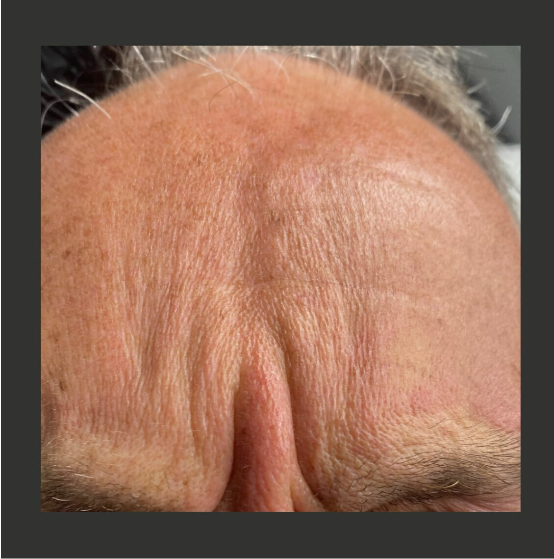 Smooth out wrinkles. GENTRY & RESOLVE AESTHETICS.