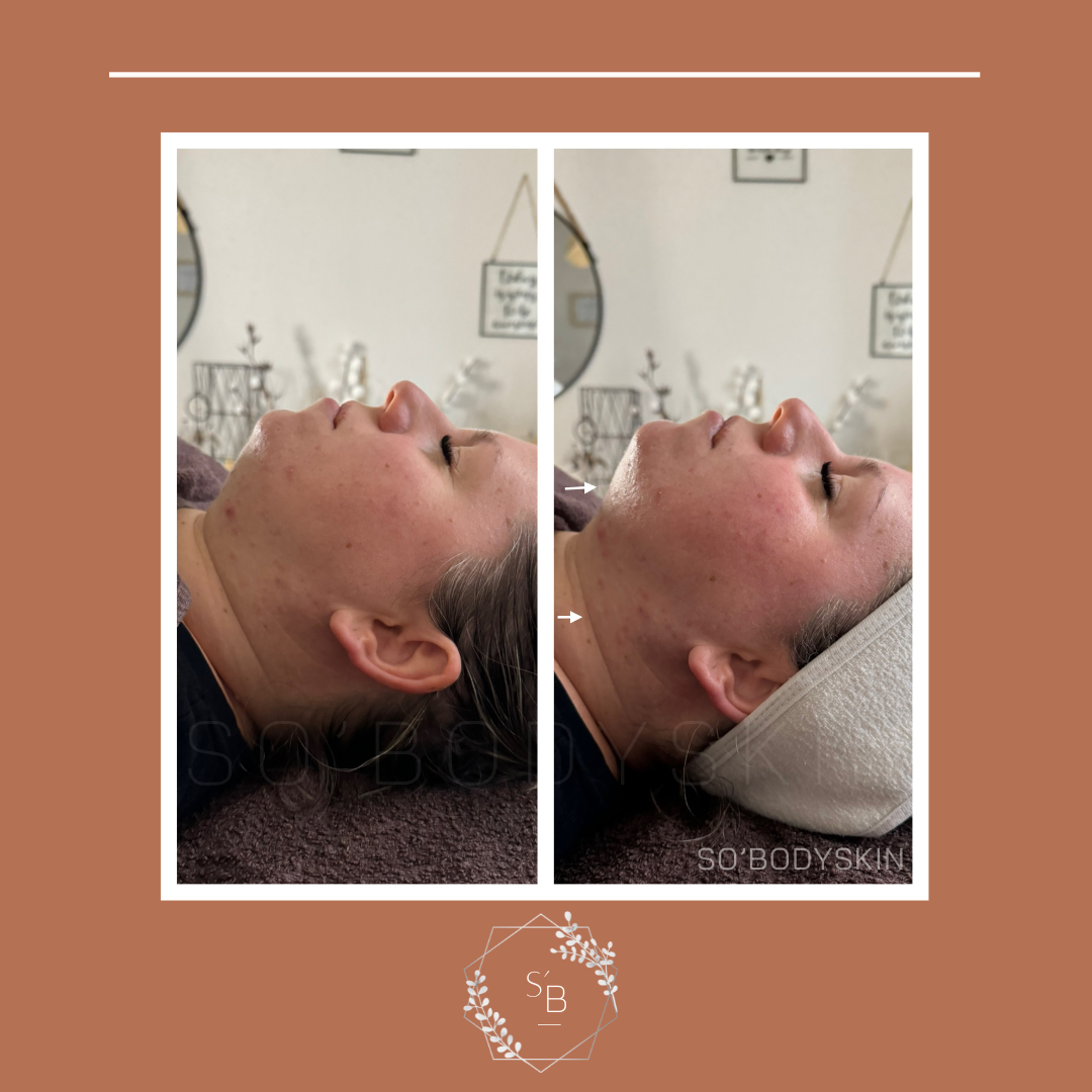 Soin Expert anti-âge - Résultat en 1 séance