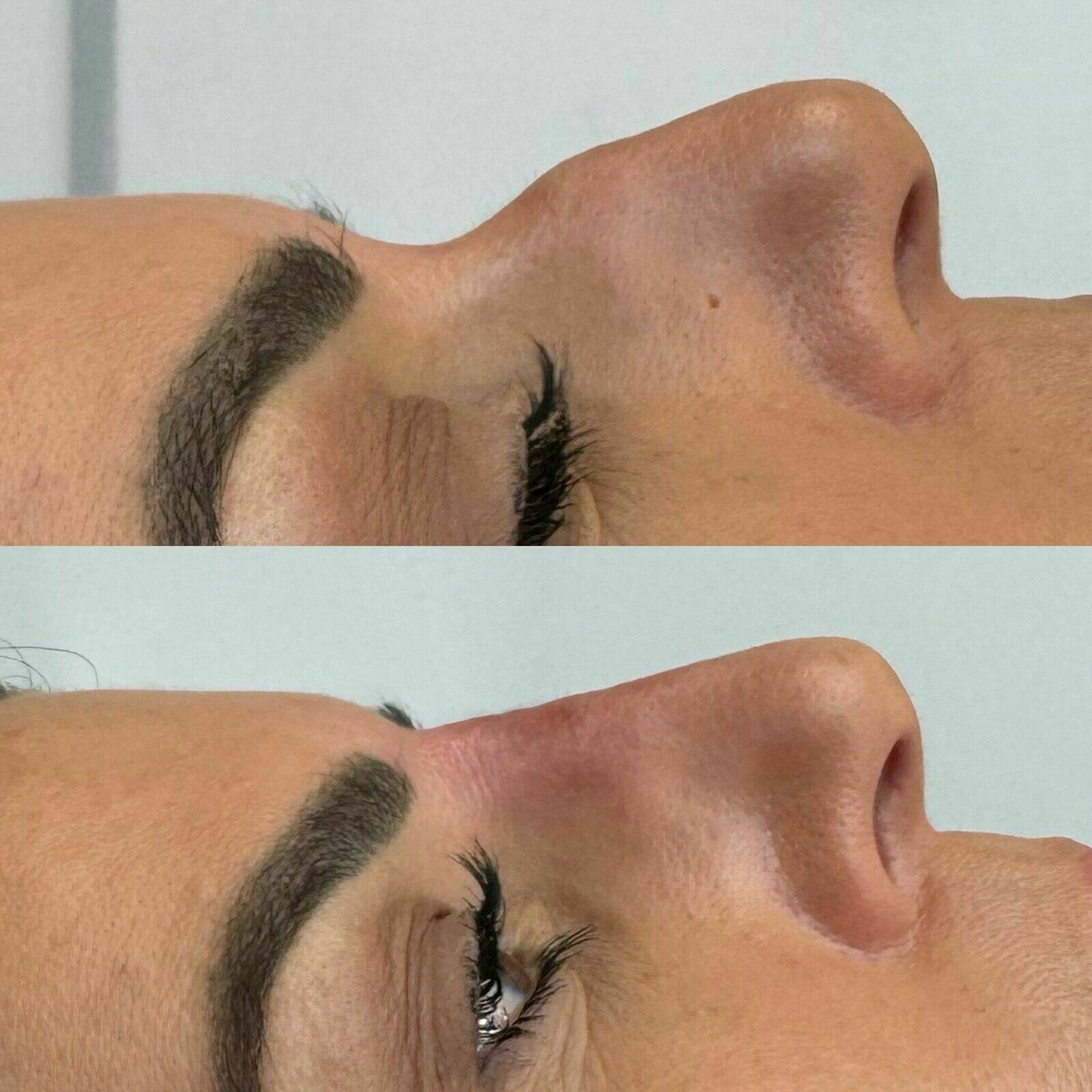 Liquid Rhinoplasty