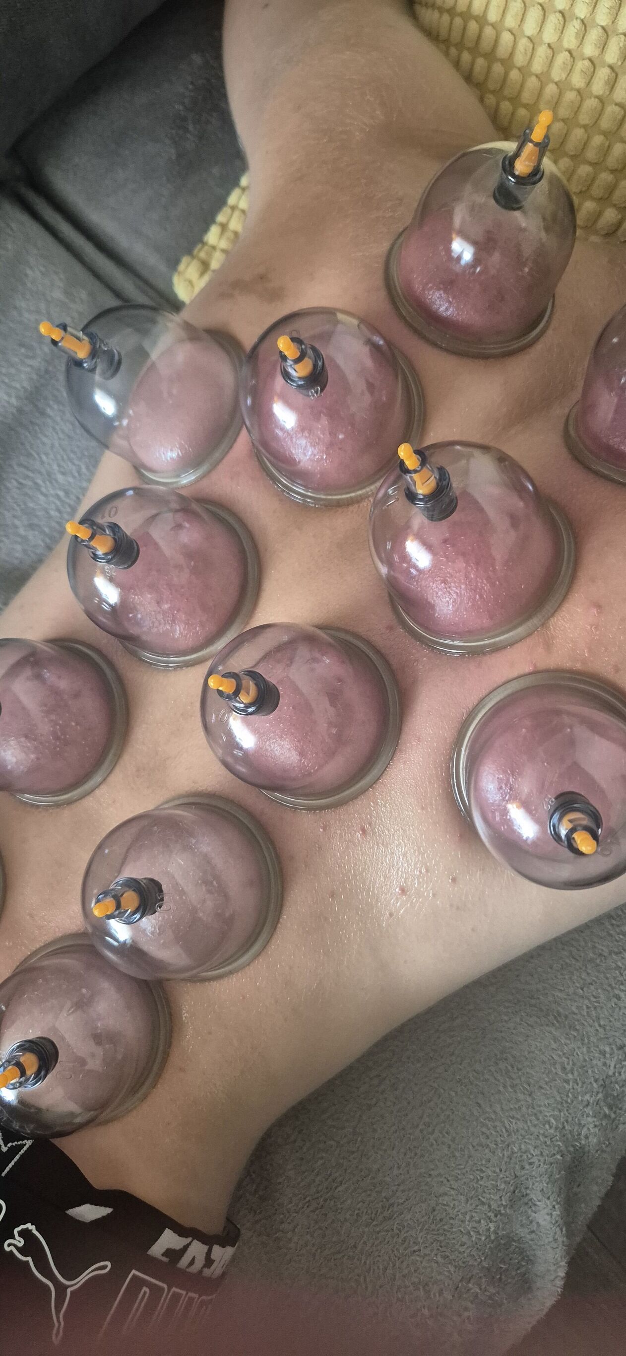 Pose de Ventouses en pose fixe pour douleurs dorsales . Adolescent 14 ans . 