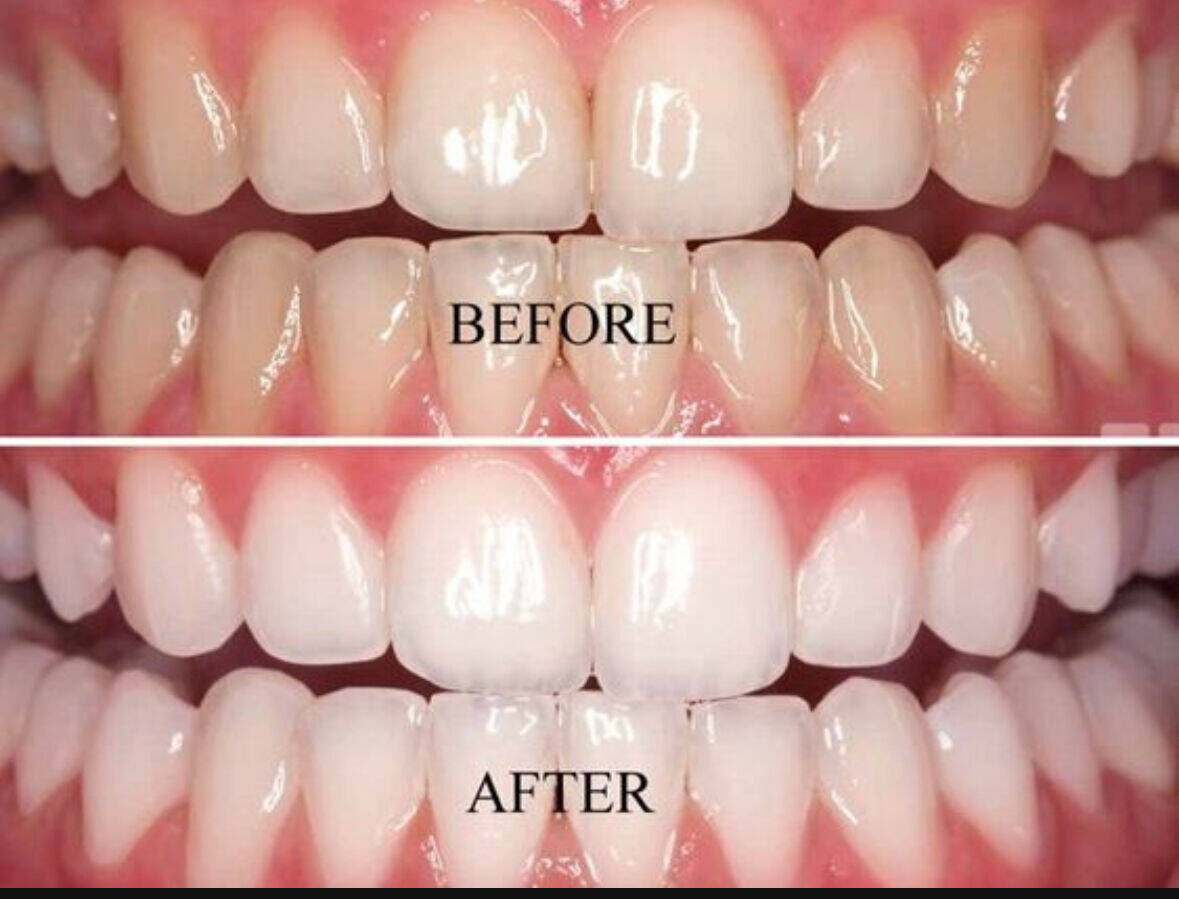 Blanchiment dentaire 