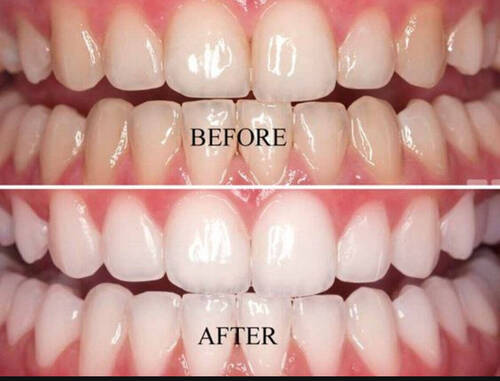 Blanchiment dentaire 