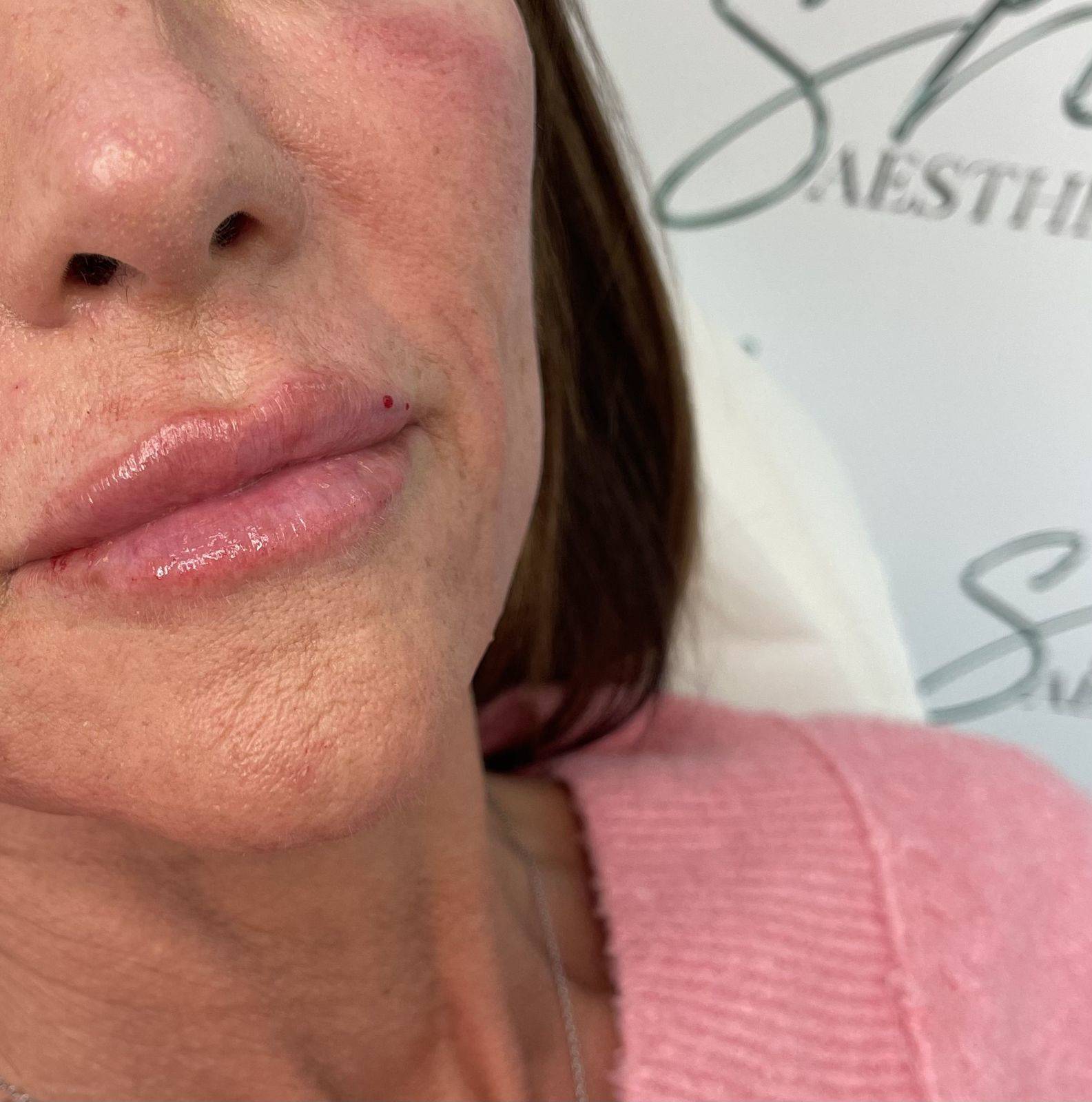 1.1ml Lip Enhancement 