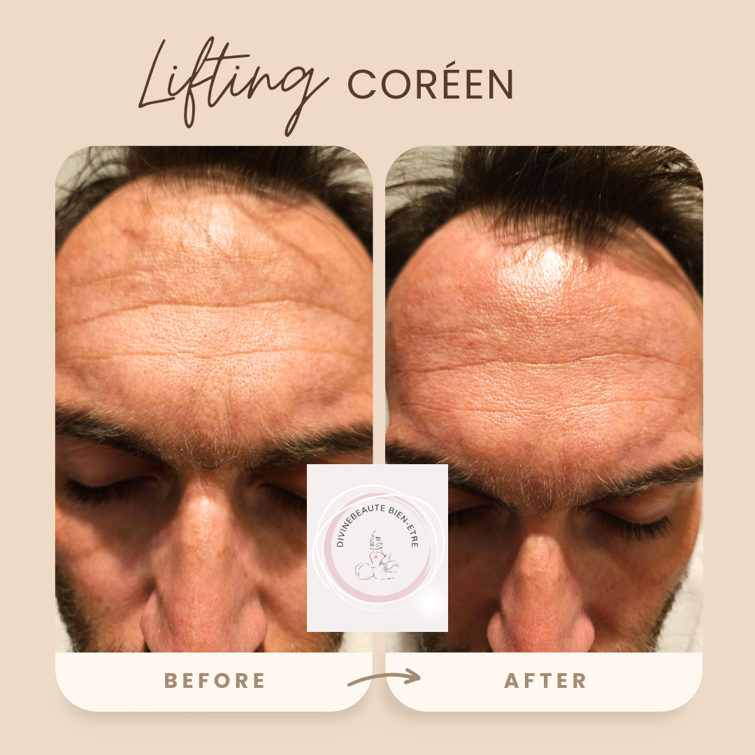 Lifting coréen 1 zone 3 séances 