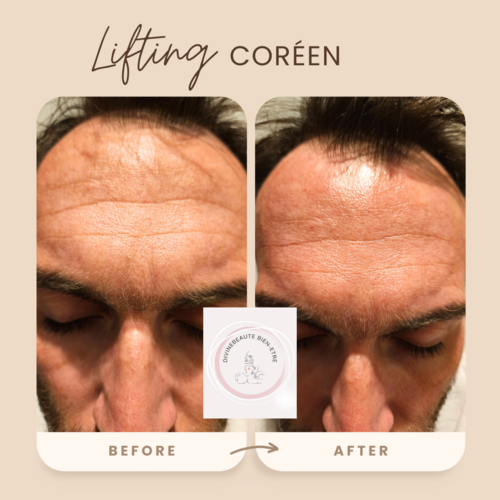 Lifting coréen 1 zone 3 séances 