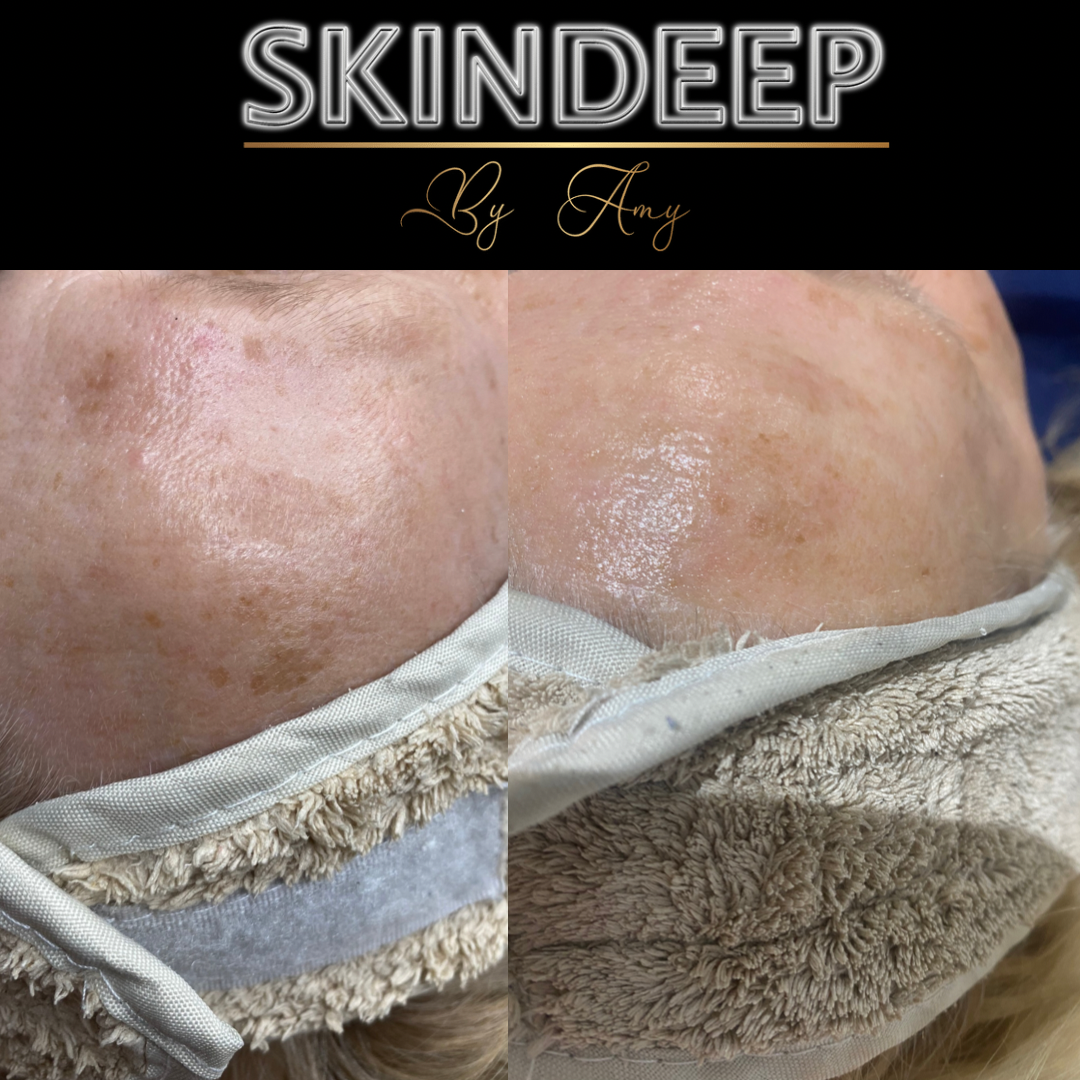Before & After pigmentation - Treated with a course of Chemical peels & Microneedling