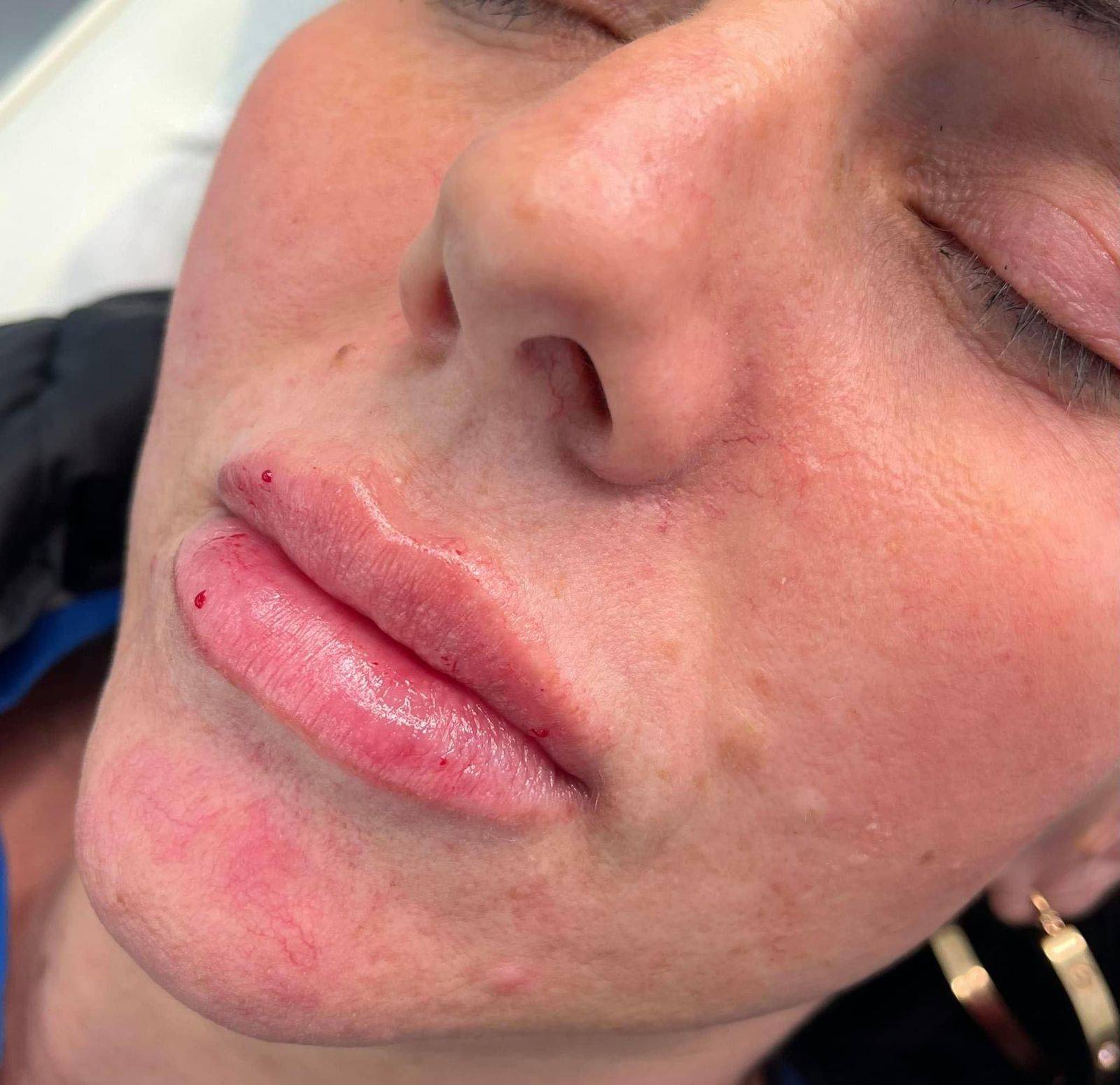 1.1ml Lip Enhancement 