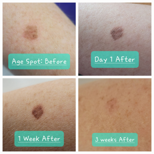 Cryopen Age Spot Treatment - 3 weeks