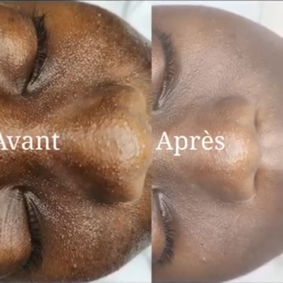 Hydraface