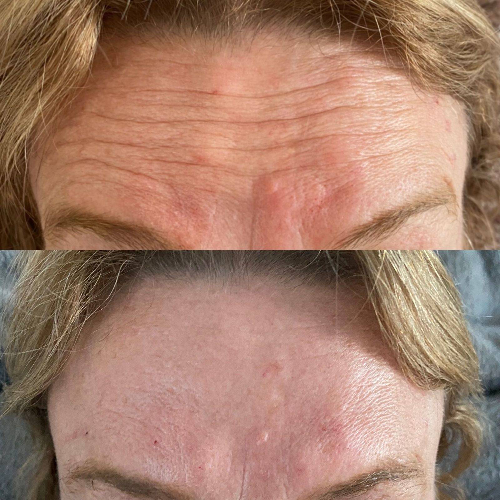 Botox Before and Afters