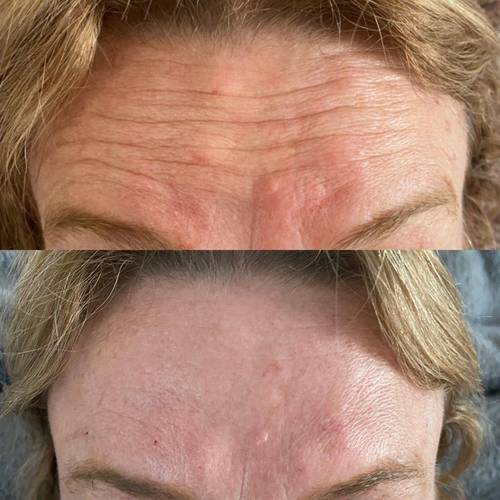 Botox Before and Afters