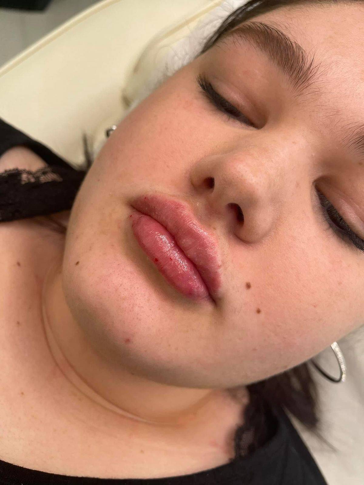 1.1ml Lip Enhancement 