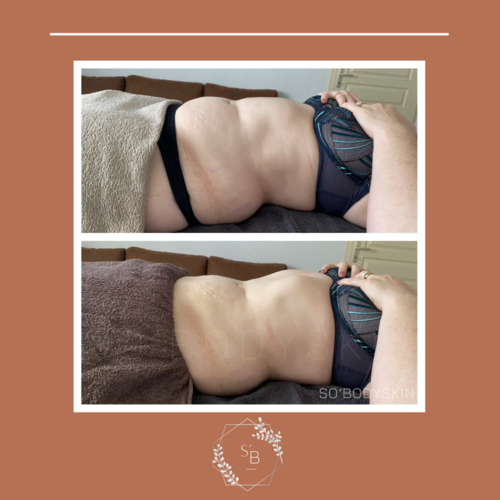 Drainage Lymphatique Brésilien - Résultat en 1 séance