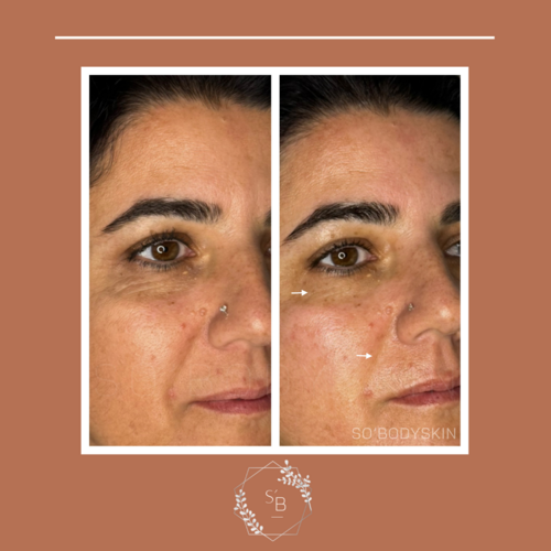 Soin Expert anti-âge - Résultat en 1 séance