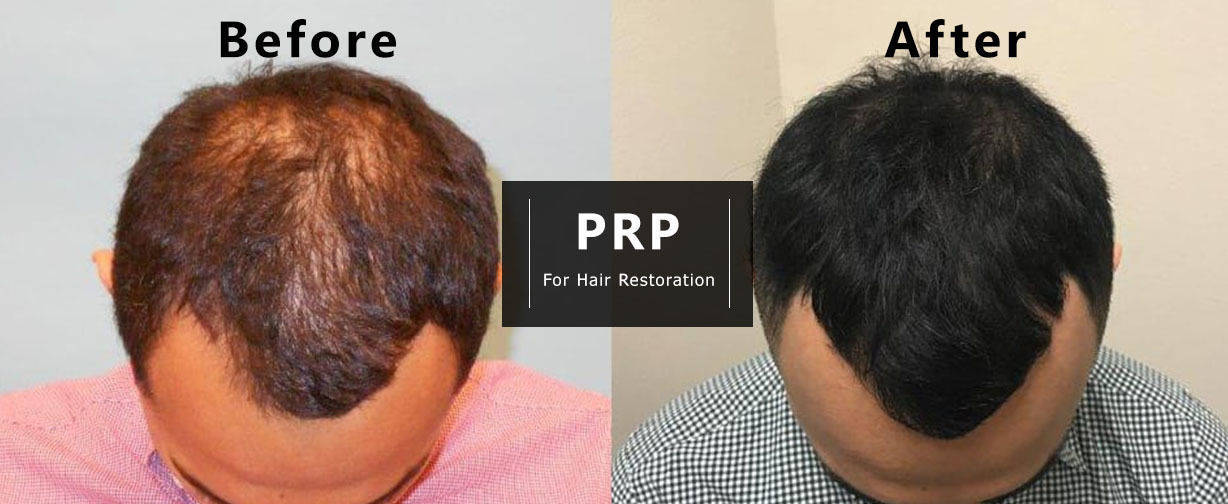 PRP Hair Loss Injections (Block of 6)
