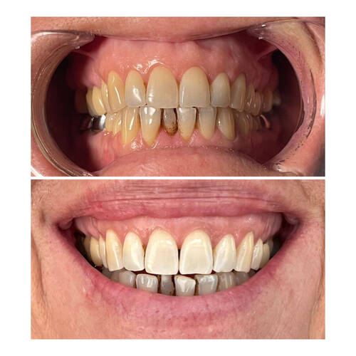 Résultat après 1 séance blanchiment dentaire sur personne fumeuse 