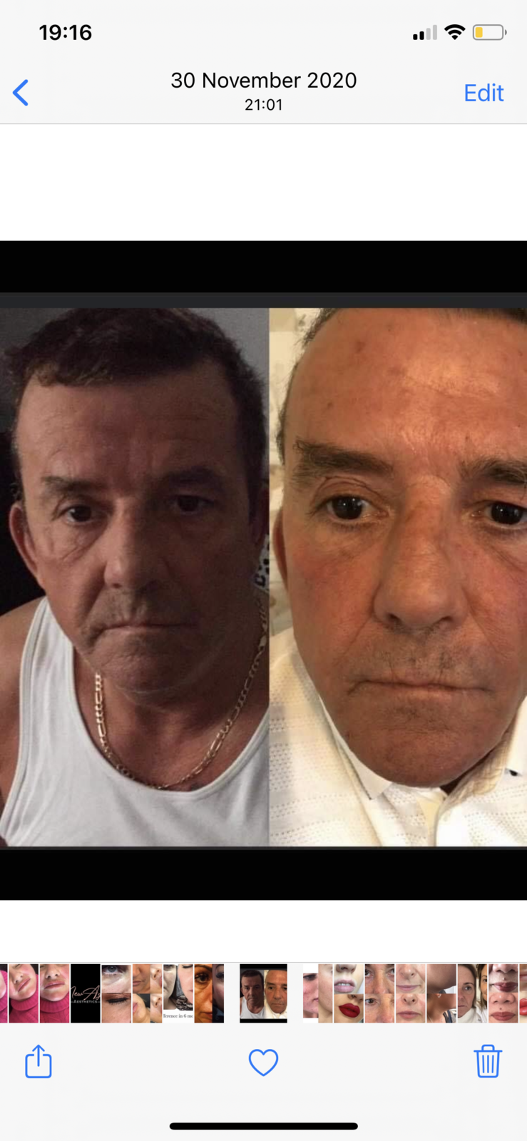 Botox Before and Afters