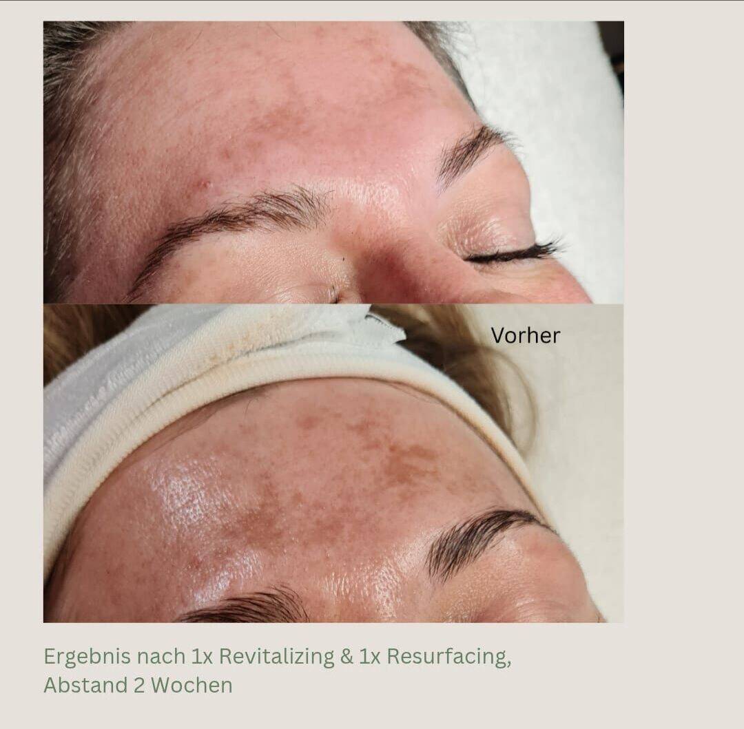 Bio-Mikroneedling. 2 Behandlungen in Abstand von 14 Tagen. 