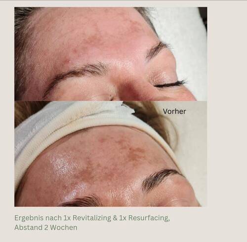 Bio-Mikroneedling. 2 Behandlungen in Abstand von 14 Tagen. 