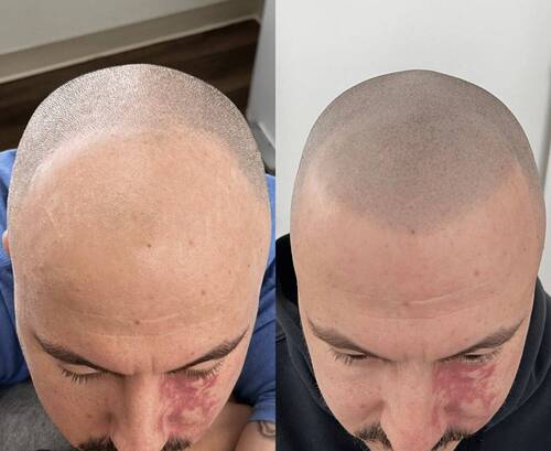 SMP Treatment Before and After Results 