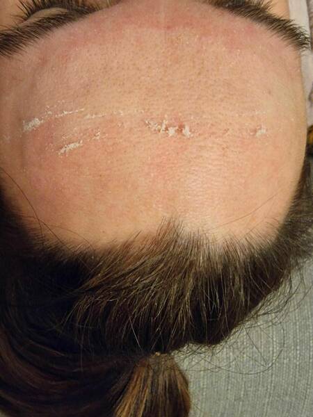 Old skin (top of the forehead) New skin (bottom of the forehead)