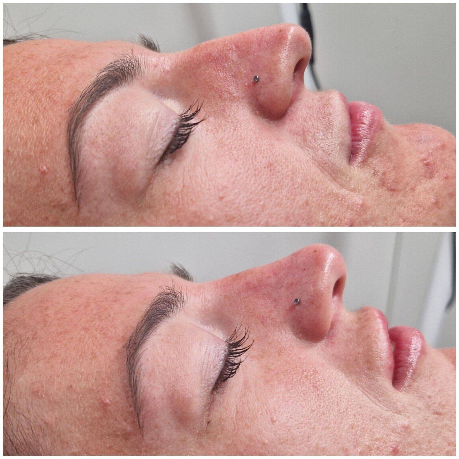 Non-Surgical Rhinoplasty (nose)