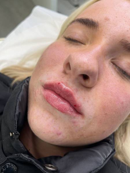 1.1ml Lip Enhancement 