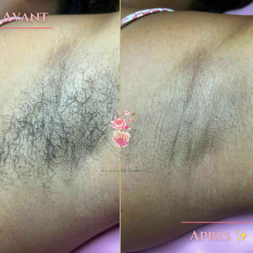 Avant/après épilation des aisselles