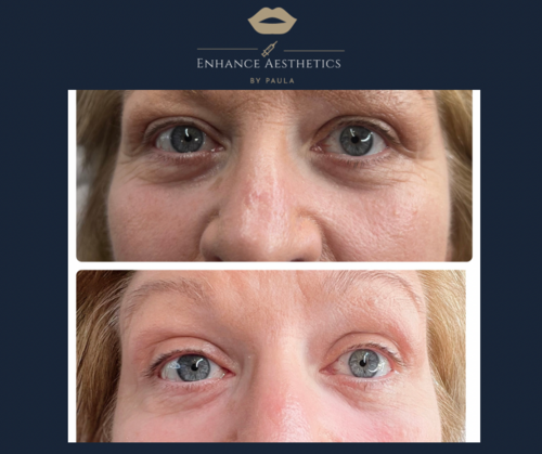 Tear Trough Filler before and after