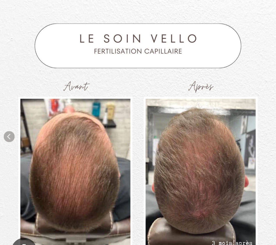 Cure Vello Homme 6 passages sur 3 mois