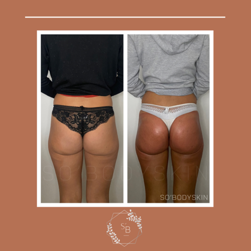 Lifting Colombien - Résultat en 5 séances