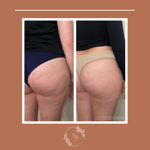 Pack Minceur (Lipocavitation + Radiofréquence) - Résultat en 4 séances