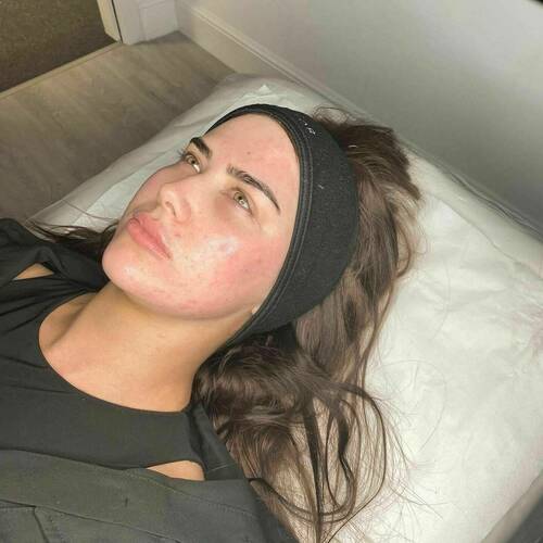 Rejuvenation Anti-aging Facial including Microneedling. Focusing on previous scaring and textural issues. 