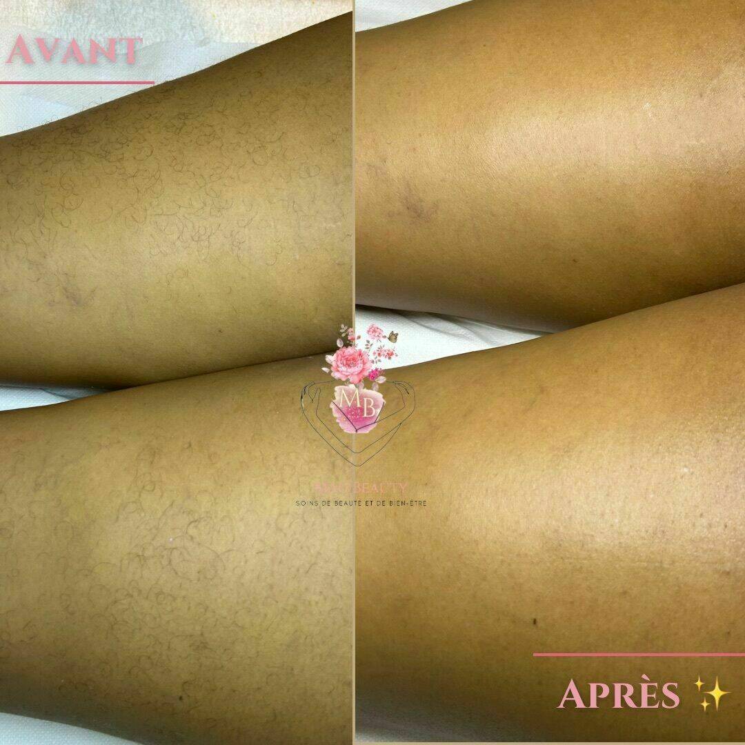 Avant/après épilation des cuisses