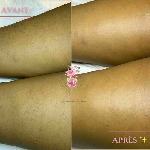 Avant/après épilation des cuisses